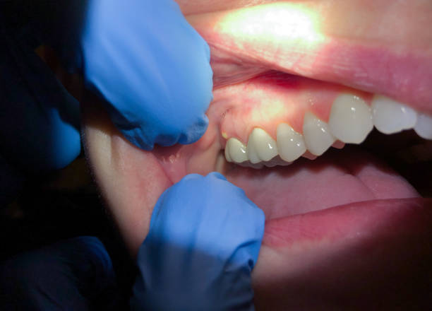 Best Knocked-Out Tooth (Avulsed Tooth) Treatment in Esparto, CA